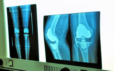 A Guide to Orthopaedic Joint Replacements