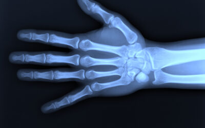 Dupuytrens Contracture & Other Conditions of the Hand