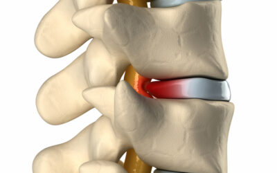 What is a Herniated Disc